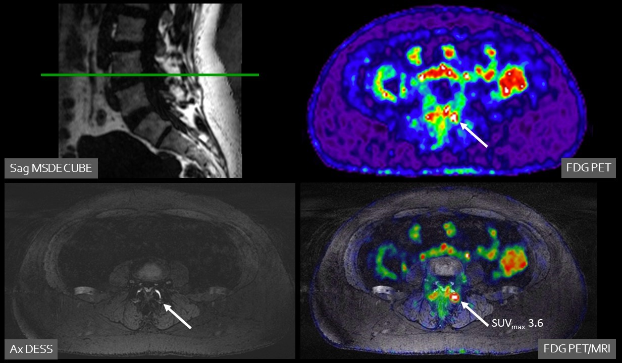A 47-year-old female patient with chronic pain in the left lower back/buttock with unknown cause. PET demonstrated focally increased FDG uptake at the left facet L3-4 l. MRI shows minimal fluid, but no edema. Follow-up PET-MRI after six months shows a similar pattern. The patient is on the waiting list for targeted facet joint infiltration (typically not covered by insurance in the Netherlands).