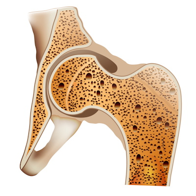 2021 12 15 05 32 3560 Osteoporosis 400