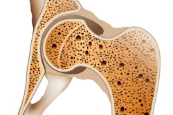 2021 12 15 05 32 3560 Osteoporosis 400