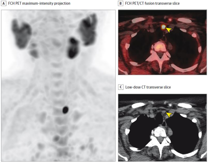 2024 05 20 Pet Ct Over Spect Ct Hyperparathyroidism Quak