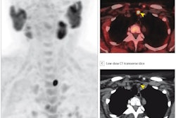 2024 05 20 Pet Ct Over Spect Ct Hyperparathyroidism Quak