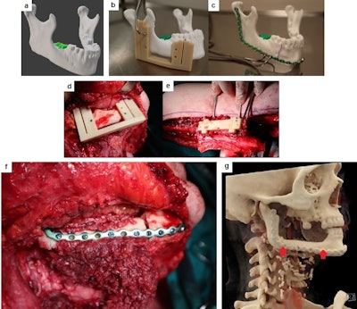 A CAD representation (a) and 3D printed model (b, c) of the pathologically altered mandible were created for preoperative planning and osteosynthetic plate prebending. Personalized surgical guides designed for mandible reconstruction surgery with free fibula flap are shown (d, e). The fitting of the flap's bone fragment to the native mandible post plate fixation is depicted (f). A cinematic-rendering reconstruction from a follow-up CT scan, taken 13 months after the reconstruction surgery, demonstrates complete healing of the bone fragment; its edges are marked with red arrows (g). All figures courtesy of Dr. Vjekoslav Kopačin, PhD, Department of Diagnostic and Interventional Radiology, University Hospital Center Osijek, Croatia, and presented at ECR 2024.