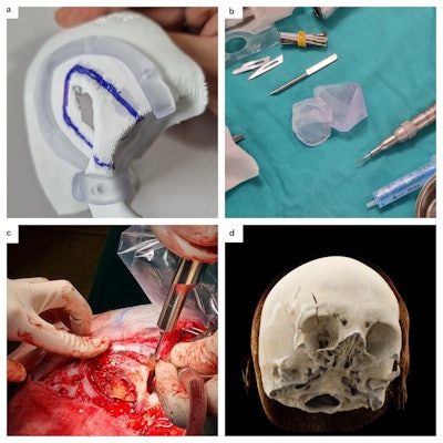 3D printed model of the osteolytic skull lesion in right fronto-orbital region was created for preoperative planning with 3D printed personalized surgical guide (a), 3D printed mold for personalized graft generation (b), osteotomy using the personalized surgical guide, CRT reconstruction shows impeccable fit and alignment of the molded graft.
