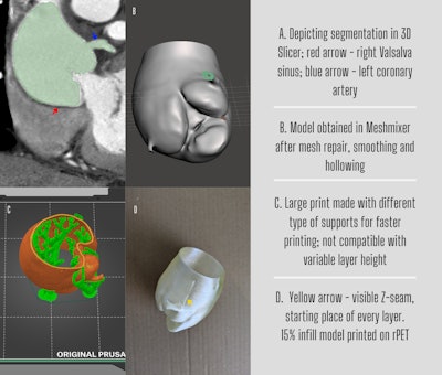The model was used to provide an initial understanding of the actual size of the aneurysm and the position and course of both coronary arteries. Total printing time was around 7.5 hours. All figures courtesy of Dr. Sabin Cristian Radu, Prof. Bogdan Popa, et al and presented at ECR 2024.