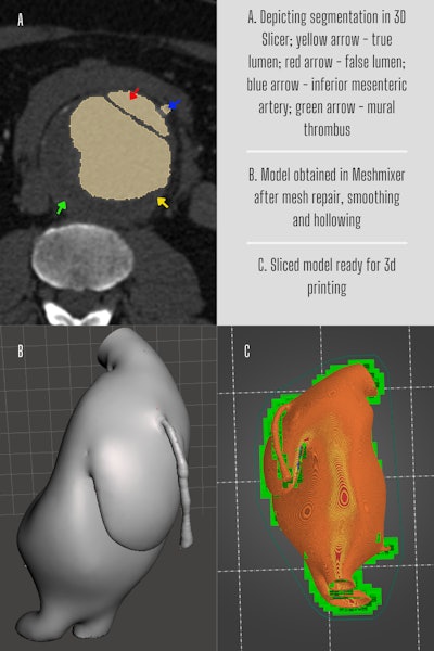 Fusiform aneurysm measuring about 7/7/10 cm AP/TR/CC with mural thrombus measuring 2.5 cm and small dissection (false lumen measuring 3.5/1.2 cm). Periaortic hematoma was noted measuring 1.7 cm; iliac arteries with normal caliber and no active bleeding reported. The model was used to assess infrarenal neck angle and shape, position, and course of inferior mesenteric artery.