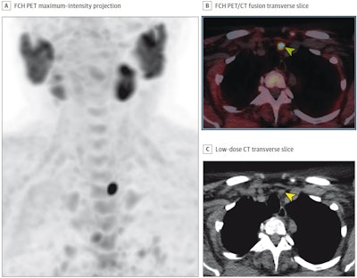 (A) FCH-PET maximum-intensity projection; (B) FCH-PET/CT fusion transverse slice; and (C) low-dose CT transverse slice, showing high FCH uptake in an 11-mm left inferior parathyroid adenoma (arrowheads). The patient underwent minimally invasive parathyroidectomy, leading to normocalcemia during follow-up. No complications occurred.