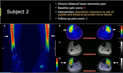 F-18 FTC-146 PET/MRI scan of a 21-year-old male soccer player who participated in the trial. The man had chronic bilateral lower expremity pain with a baseline pain score of 8 out of 10. Based on the finding, the patient underwent anesthetic injections and nerve blocks at the site of radiotracer uptake and reported a pain score of two on a follow-up visit.
