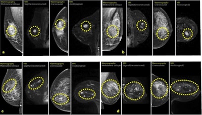 La inteligencia artificial aumenta 4 veces la detección de cáncer de mama mediante resonancia magnética