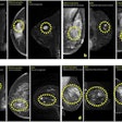 2024 07 08 Nature Med Breast Mri Ai