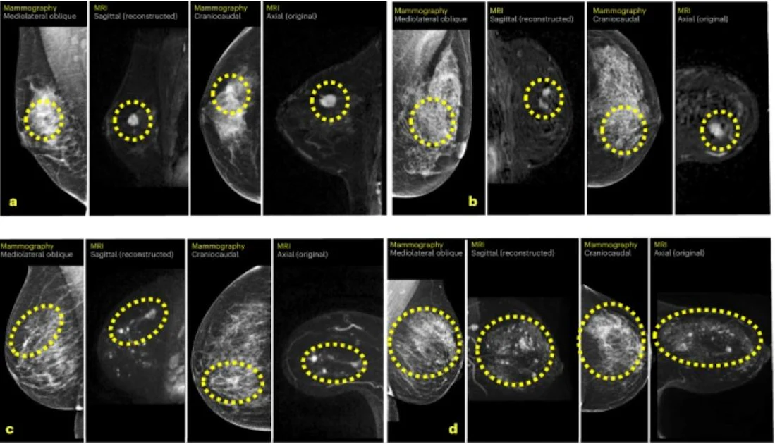 AI increases breast MRI's cancer detection 4-fold | AuntMinnieEurope
