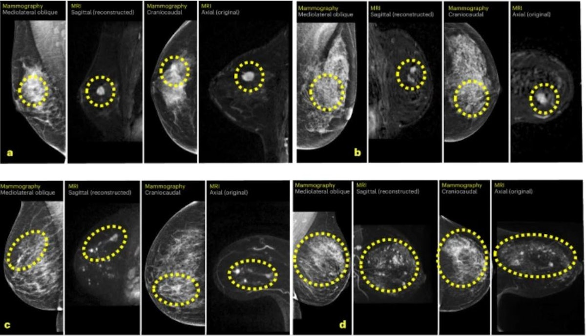 AI increases breast MRI’s cancer detection 4-fold