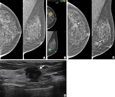 Imaging in a 56-year-old woman with heterogeneously dense breasts (BIRADS C). (A) Left craniocaudal (left) and mediolateral oblique (right) digital mammograms show no abnormality. (B) Left craniocaudal (LCC, top) and left mediolateral oblique (LMLO, bottom) mammograms with retrospectively applied AI (Lunit Insight MMG, version 1.1.7.1; Lunit) show the lesion was given abnormality scores of 97% and 71%, respectively. The color bar indicates pixel-level abnormality scores corresponding to heatmap contour lines. Breast ultrasound performed the same day was considered negative (not shown). (C) Left craniocaudal (left) and mediolateral oblique (right) digital mammograms acquired nine months later show an irregular mass (arrows) in the left breast, which correlates with the heatmap areas scored as 97% and 71% by AI in the earlier screening mammogram (B). The radiopaque round marker denotes the site of the palpable abnormality indicated by the patient. (D) Transverse ultrasound imaging shows an irregular mass (arrow) in the left breast. The patient was treated with breast-conserving surgery, and the mass was proven to be invasive lobular carcinoma. Image courtesy of the RSNA.