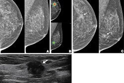 2024 07 23 Radiology Mammo Ai
