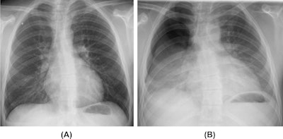Barotrauma in a cannabis smoker. A 21-year-old man who is a habitual cannabis smoker presented to the emergency department with right-sided sudden chest pain and dyspnoea. (A) Inspiratory posteroanterior chest radiograph reveals a small right superior pneumothorax. (B) Expiratory posteroanterior chest radiograph better demonstrates the right-sided pneumothorax.