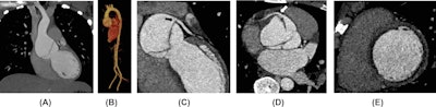 Cocaine-related aortic dissection. A 28-year-old man with a history of cocaine consumption presented with severe chest pain. (A) Thoracic aorta coronal CT angiogram reveals a dissection flap within a dilated aortic root. (B) 3D CT aortic angiogram reconstruction demonstrates isolated aortic root involvement without extension to the remaining aorta. (C and D) ECG-gated coronary CT angiogram reformats illustrate the dissection flap running from the aortic valve to the sinus level and extending into the left main coronary artery (black arrow). The right coronary artery was also affected by the dissection (white arrow). (E) ECG-gated coronary CT angiogram in a short-axis view shows diffuse subendocardial hypodensity concerning associated myocardial ischemia. All images courtesy of Drs. Adrià Roset-Altadill, Monika Radike, Dennis Wat and EJR.