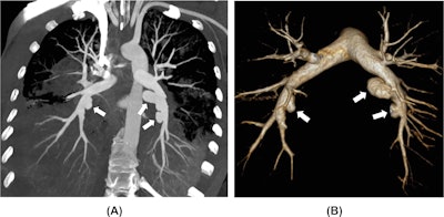 A 35-year-old woman with a history of multiple drug abuse presented with general discomfort, fever, chest pain, cough, and massive hemoptysis. Blood cultures were positive for Streptococcus anginosus, but no signs of endocarditis were found on echocardiography. (A) CT pulmonary angiogram maximum intensity projection (MIP) reformatting shows multiple pulmonary artery saccular outpouchings (white arrows) within the consolidated lower lobes. (B) 3D CT pulmonary angiogram reconstruction better depicts the saccular dilatations of the inferior lobar pulmonary arteries in keeping with infectious pseudoaneurysms (white arrows).