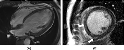 Amphetamine-associated cardiomyopathy. A 42-year-old man with a known history of amphetamine consumption presented with heart failure symptoms. (A) Cardiac MR four-chambers SSFP image in an end-diastolic phase reveals a severely dilated left ventricle. Functional analysis showed a severely decreased left ventricular ejection fraction. (B) Short-axis late gadolinium enhancement slice depicts faint septal mid-wall and lower insertion point fibrosis (white arrows).
