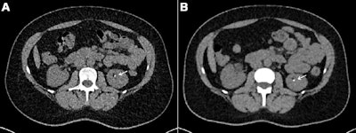 Axial contrast-unenhanced abdominal CT examinations in a 38-year-old female patient with a body mass index (calculated as weight in kilograms divided by height in meters squared) of 31.23 with known renal calculi for recurring events of flank pain. The patient underwent (A) dose-optimized energy-integrating detector CT (1.49 mSv) and (B) submillisievert photon-counting detector CT (0.94 mSv). Images from both examinations showed a 3-mm calculus in the left kidney (arrows). Images and caption courtesy of the RSNA.