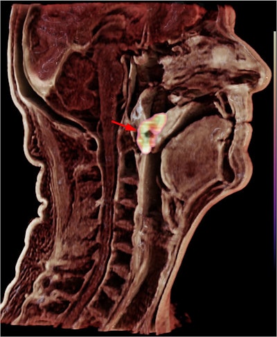 Signa PET/MR scanner (GE HealthCare, Waukesha, WI) MR image: T1-weighted LAVA-flex, repetition time, 4.65 ms; echo time, 1.82 ms; flip angle, 15°; slice thickness,1.3 mm; spacing, 2.6 mm; field of view; 100 mm; total acquisition time; 1:31 minutes. PET image: 245 MBq of F-18 FDG, bed time, 1:30 minutes; reconstructed using block-sequential regularized expectation maximization. Image courtesy of Huellner et al. Licensed under CC BY 4.0.