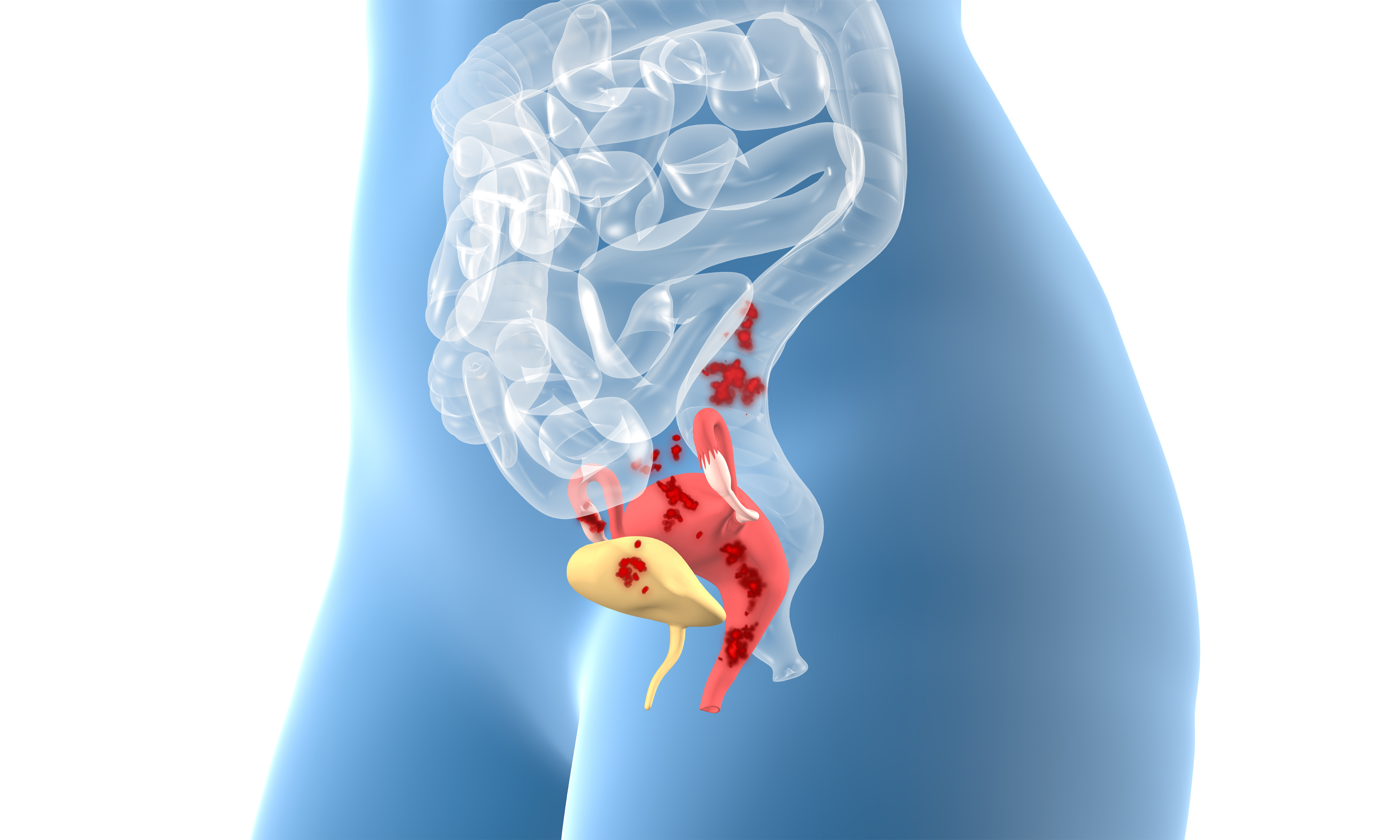 Endometriosis 3 D Illustration