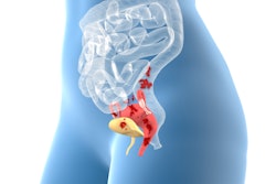 Endometriosis 3 D Illustration