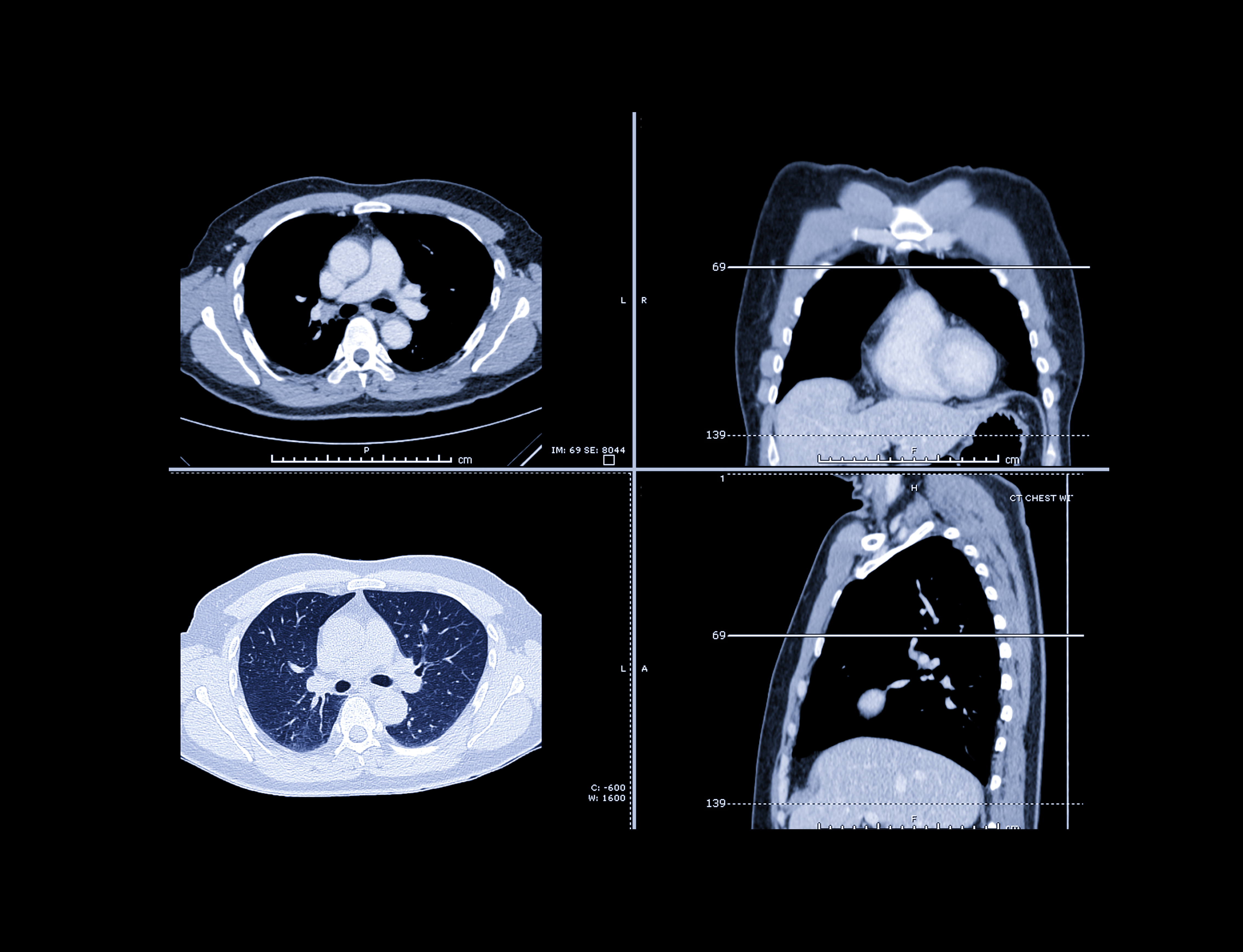 Lung Ct Images