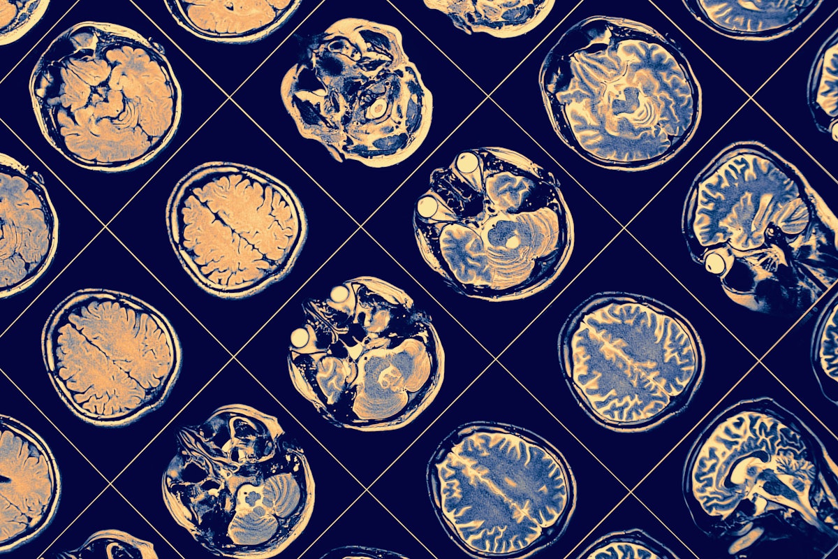 MRI predicts Parkinson’s disease progression