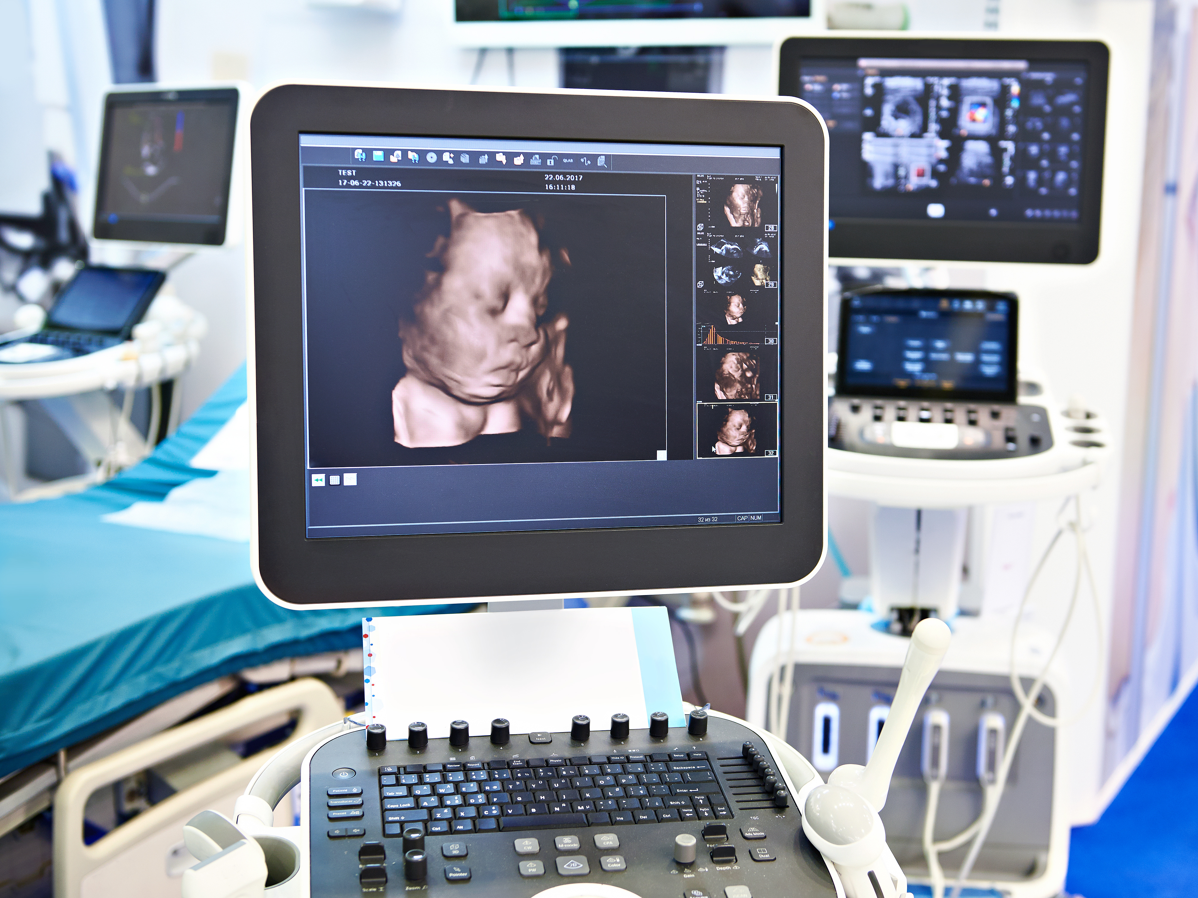 Ultrasound 3 D Fetal Head