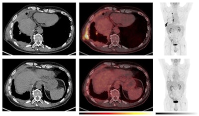 Example of a patient with a decline in metabolic tumor volume (MTV) and F-18 FDG uptake as early as the week-five PET scan, which was followed by a long-term objective tumor response. Comparative imaging from baseline (top row) and week five (bottom row). To the left, axial CT images; in the middle, axial PET/CT images; and to the right, the maximum intensity projection (MIP). The PET images are observed within a 0-10 SUV window. The patient was classified as having stable disease at the first CT response assessment, before developing partial response at the week-12 CT scan according to the modified Response Criteria in Solid Tumours (mRECIST) and immune RECIST. While the patient had stable disease at the week-5 CT scan, PET/CT already showed a reduction in MTV and a decline in [F-18] FDG uptake in the tumor. The treatment was discontinued after seven months due to intolerable toxicity. The patient is still under follow-up 20 months after the start of the treatment. All figures courtesy of Dr. Solfrid Thunold et al and EJNMMI.