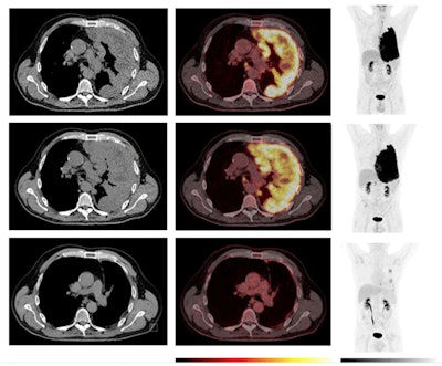 Example of a patient with a pseudoprogression. An initial increase in tumor volume and MTV and a decline in F-18 FDG uptake at week five was followed by a long-term objective tumor response/disease control. Comparative imaging from baseline (top row), week five (middle row), and year one (bottom row). To the left, axial CT images; in the middle, axial PET/CT images; and to the right, the MIP. The PET images are observed within a 0-10 SUV window. The patient was classified as having progressive disease at the first CT response assessment, before developing stable disease at week 12 and partial response at the week 18 CT scan according to mRECIST and immune RECIST. At week five, the PET/CT showed an increase in MTV, while F-18 FDG uptake (SUVmax and SUVpeak) has started to decline. At the one-year follow-up PET/CT, there is a notable change, with a visible reduction in tumor size, MTV, and F-18 FDG uptake. This corresponded with clinical performance status, which was reduced at week five and improved from week 12 and onwards. The patient died due to disease progression two years after the start of the treatment.