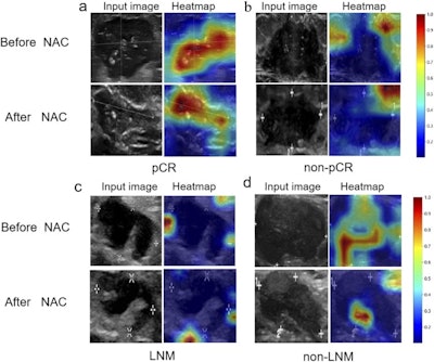 Feature heat maps based on Grad-CAM. Color-code heat maps overlaid with the corresponding ultrasound images are shown for four patients who were accurately predicted. (a, d) The heat maps highlighted the intratumor region in patients with complete pathologic response or non-lymph node metastasis. (b, c) The heat maps highlighted the peritumor tissue in patients with non-complete response or metastasis. Images are being republished through a Creative Commons license (CC BY-NC-ND 4.0). Image courtesy of Academic Radiology (Elsevier).