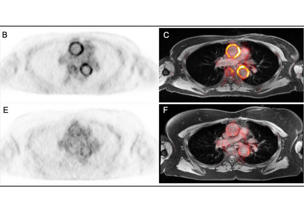 2024 08 25 Natcomms Pet Mri Treatment Response Lvv Pugh Thumbnail