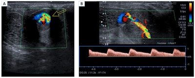 Nonischemic or high-flow priapism. Color Doppler in the transverse plane (A) and spectral Doppler in the longitudinal plane (B). Turbulent flow of the left cavernous artery is observed (arrow). The lesion shows a low resistance pattern, with increased systolic and diastolic velocities. These findings are related to a penile pseudoaneurysm.