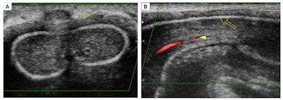 Superficial dorsal vein thrombosis. Color Doppler in transverse (A) and longitudinal (B) planes. The images show an absence of signal from the superficial dorsal vein of the penis and echogenic material related to thrombus (arrow). Presence of flow in the cavernous artery (arrowhead). All figures courtesy of Dr. Iñigo Zubiaguirre Telleria et al and European Society of Radiology (ESR) EPOS database.