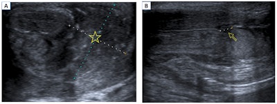 Penile fracture. B-mode ultrasound in the transverse (A) and longitudinal (B) planes. A large extratunical hematoma can be seen adjacent to the erectile bodies of the penis (star). In the longitudinal plane, a loss of continuity of the tunica albuginea (arrow) confirms its rupture.