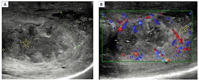 Abscess. B-mode ultrasound image (A) shows a heterogeneous collection with a central hypoechoic area and detritus inside the lesion (star). Color Doppler (B) shows an increased vascularity in the peripheral soft tissues (arrow).