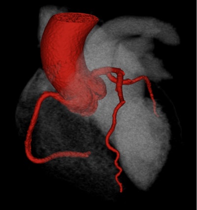 A 3D reconstruction of a CT coronary angiogram from a patient in the SCOT-HEART trial who had normal coronary arteries. All images courtesy of Prof. Michelle Williams and SCOT-HEART.