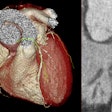 A 3D reconstruction and curved planar reformation from a CT coronary angiogram from a patient in the SCOT-HEART trial who had severe obstructive coronary artery disease.