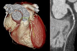 A 3D reconstruction and curved planar reformation from a CT coronary angiogram from a patient in the SCOT-HEART trial who had severe obstructive coronary artery disease.