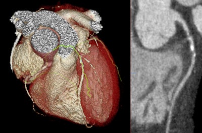 A 3D reconstruction and curved planar reformation from a CT coronary angiogram from a patient in the SCOT-HEART trial who had severe obstructive coronary artery disease.