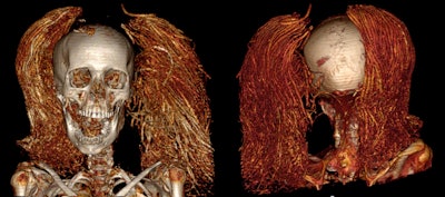 CT of the 'Screaming Woman' mummy visualizes both front and back of the wig.