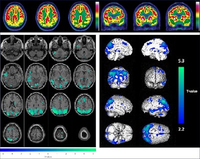 Example of the combined visual (upper panel, axial and coronal slices of brain F-18 FDG-PET images) and semiquantitative (lower panel, with hypometabolisms in green projected on axial MRI slices on the left and hypometabolisms in blue on a 3D volume rendered on the right) analysis for a 65-year-old male patient (initially diagnosed with mild cognitive impairment); these results were consistent with Alzheimer’s disease. The final diagnosis was Alzheimer’s disease and conversion to dementia after 31.5 months.