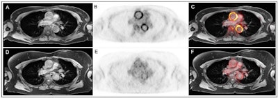 Panels A-C are images obtained at baseline. Panels D-F are images obtained from the same participant at follow-up. Panels A and D show T1-weighted MR images, panels B and E show attenuation-corrected PET, and panels C and F show fused PET/MR images. Image courtesy of Nature Communications.