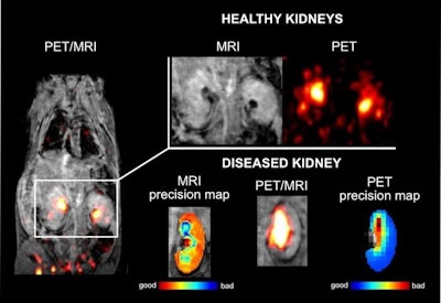 Current PET/MRI imaging of healthy and damaged mouse kidneys using the dual contrast agent F-18 [Gd (FL1)]. The imaging provides consistent signals from both PET and MRI. In healthy kidneys, the center of the kidneys appears dark in the MRI image and very bright in the PET image, indicating normal excretion of the contrast agent. The onset of impaired function in one kidney is indicated by the accumulation of the contrast agent and its slow excretion. Precise mapping of MRI and PET data ensures detailed morphological and quantitative analysis of kidney impairment. Image and caption courtesy of IOCB Prague.