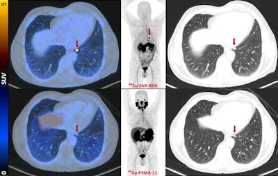Fused PET/CT, maximum-intensity projection PET, and lung-windowed CT images (from left to right) from Cu-64 SAR-BBN (top row) and Ga-68 PSMA-11 (bottom row) PET/CT study of patient demonstrating left subpleural lesion (arrows, SUVmax of 10 at 1 hour) that showed Cu-64 SAR-BBN uptake but no Ga-68 PSMA-11 uptake. PSA was 1.84 ng/mL at time of imaging. This patient underwent lobectomy, with histopathology demonstrating metastatic prostate cancer.