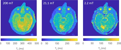 T1 maps generated after processing the field-cycling imaging scans in a 79-year-old male participant with right occipital lobe infarct. Images were processed with a total generalized variation regularization. The infarct, shown in yellow, demonstrates higher T1 relaxation time constant than the unaffected brain tissue. The infarct is clearly visible at 21.1 and 2.2 mT, where the infarct to contralateral tissue contrast ratio is higher (percentage difference in T1 of 12.3% at 200 mT, 46.6% at 21.1 mT, and 46.2% at 2.2 mT). The color bars indicate the T1 values in milliseconds. Images and caption courtesy of the RSNA.