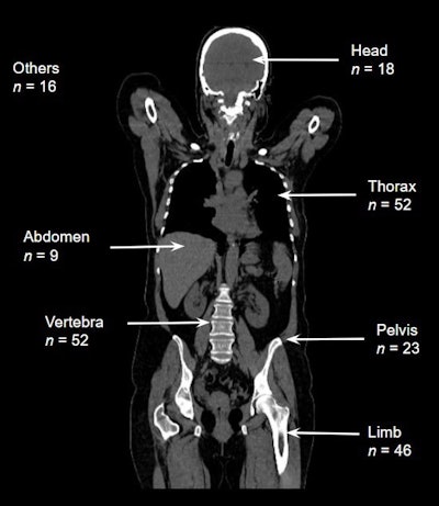 The number of patients affected by region. Images available for republishing under Creative Commons license (CC BY 4.0 DEED, Attribution 4.0 International) and courtesy of Tomography.