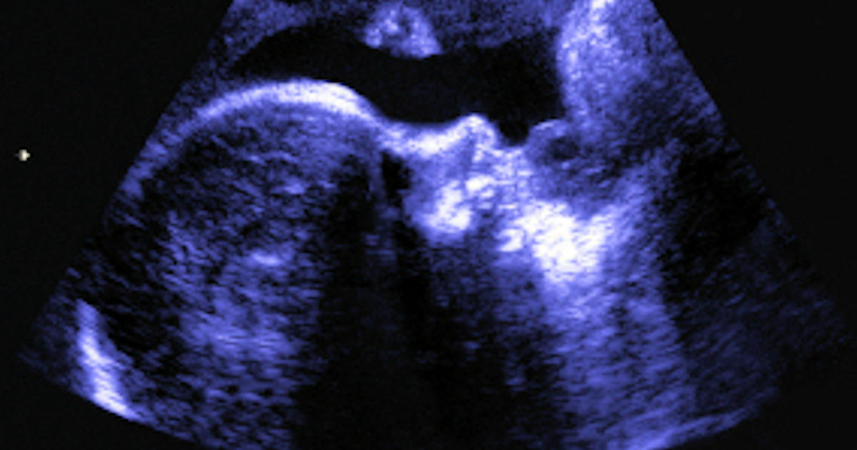 Fetal Ultrasound Social