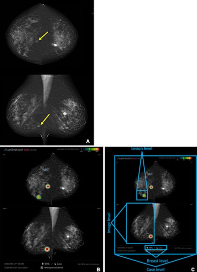 Example of an interval cancer correctly localized by the artificial intelligence (AI) algorithm. (A) Craniocaudal and mediolateral oblique screening mammogram of the right breast of a 60-year-old female patient. Arrows indicate the cancer location. (B) The same mammogram overlaid with the heatmap produced by the AI algorithm, with colored layers indexing the likelihood of cancer in the area. Red indicates the highest likelihood of malignancy (AI score = 99), while green indicates a lower likelihood of malignancy. The data are displayed on images when the lesion score is above a default AI score threshold of 10 predetermined by the manufacturer. (C) The same mammogram overlaid with an illustration of the levels of cancer detection considered in the study. Cancer was considered to be correctly localized when there was an overlap between the AI-provided heatmap and the cancer area at the lesion level. Images and caption courtesy of the RSNA.