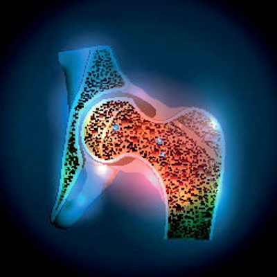 Osteoporosis Hip Joint 400